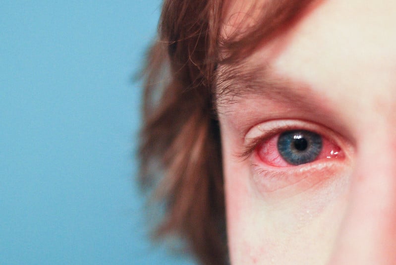 allergies-red-eyes
